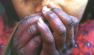 艾滋病皮疹与普通皮疹的区别是什么我分不清楚这个 艾滋病最初皮疹图片